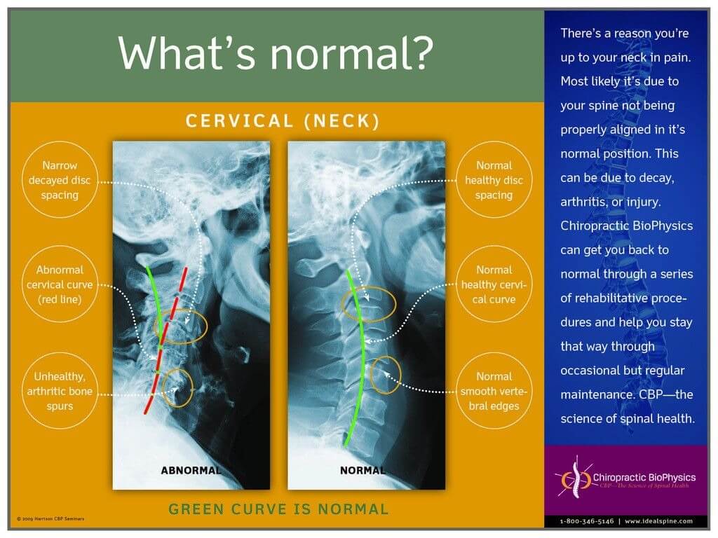 Normal Vs. Abnormal Cervical X Ray – Chiropractic Biophysics Intended For Chiropractic X Ray Report Template